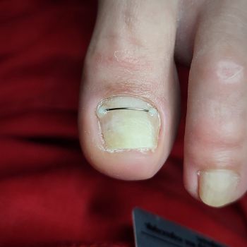 Педикюр, подолог, Івано-Франківськ 2